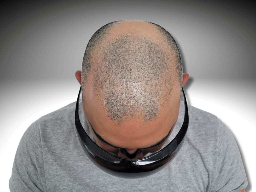 Before alopecia coverage scalp micropigmentation — Edison NJ