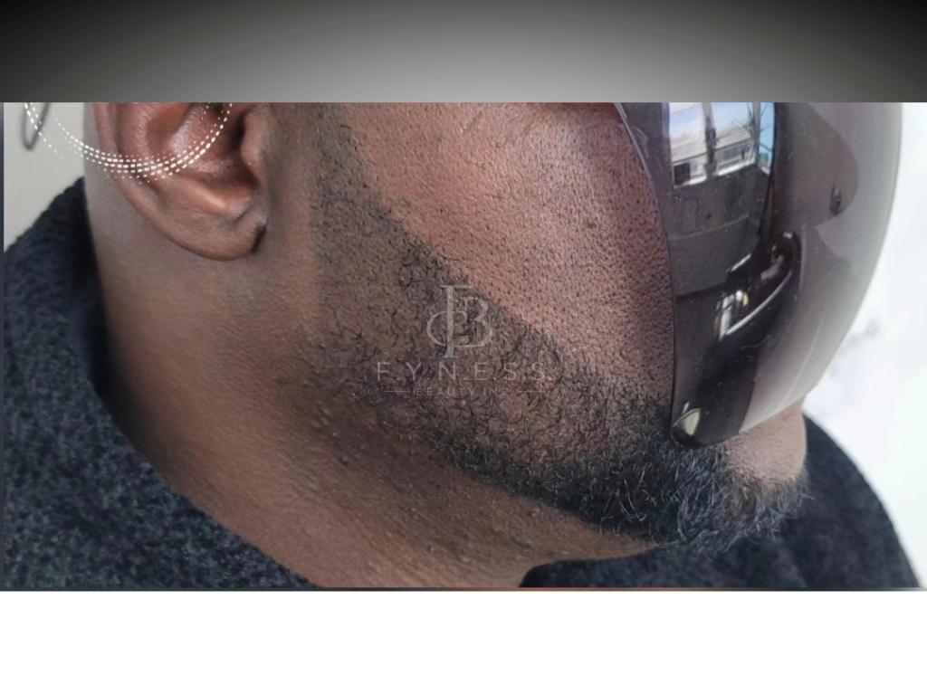 After beard micropigmentation result — Edison NJ