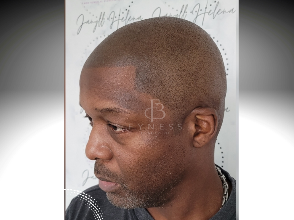 After botched SMP repair and correction result — Central NJ