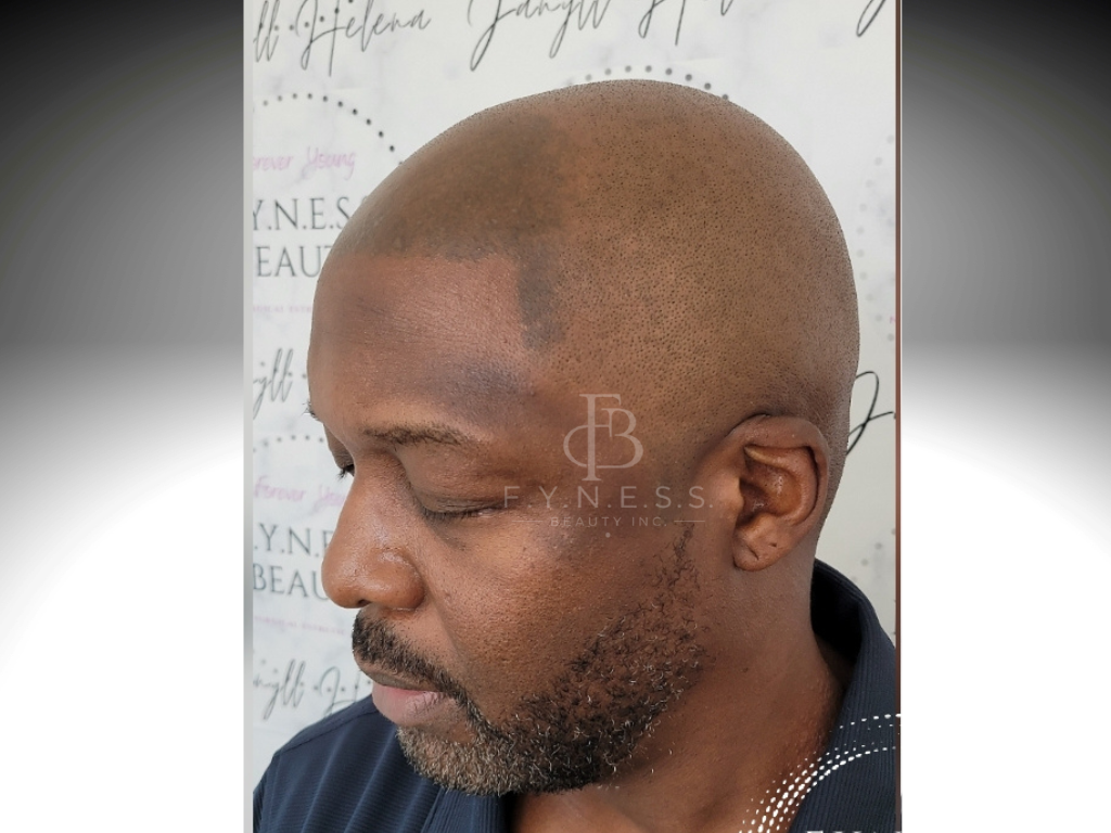 Before botched SMP repair and correction — Central NJ