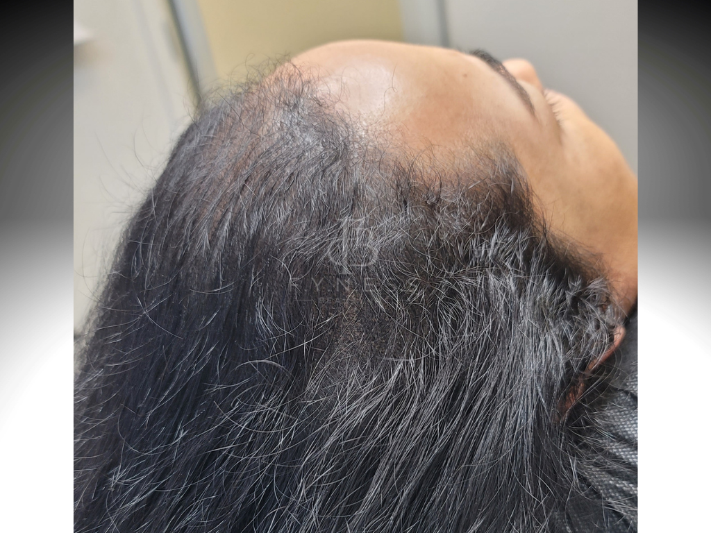After hair density enhancement scalp micropigmentation result — Edison NJ