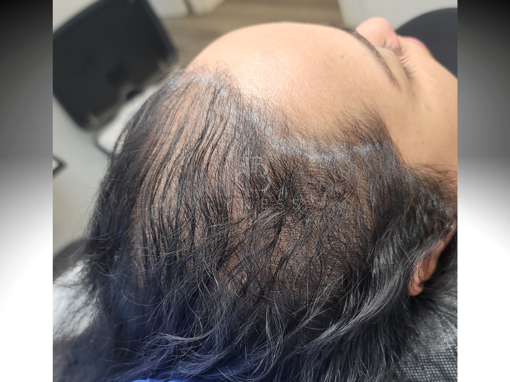Before hair density enhancement scalp micropigmentation — Edison NJ