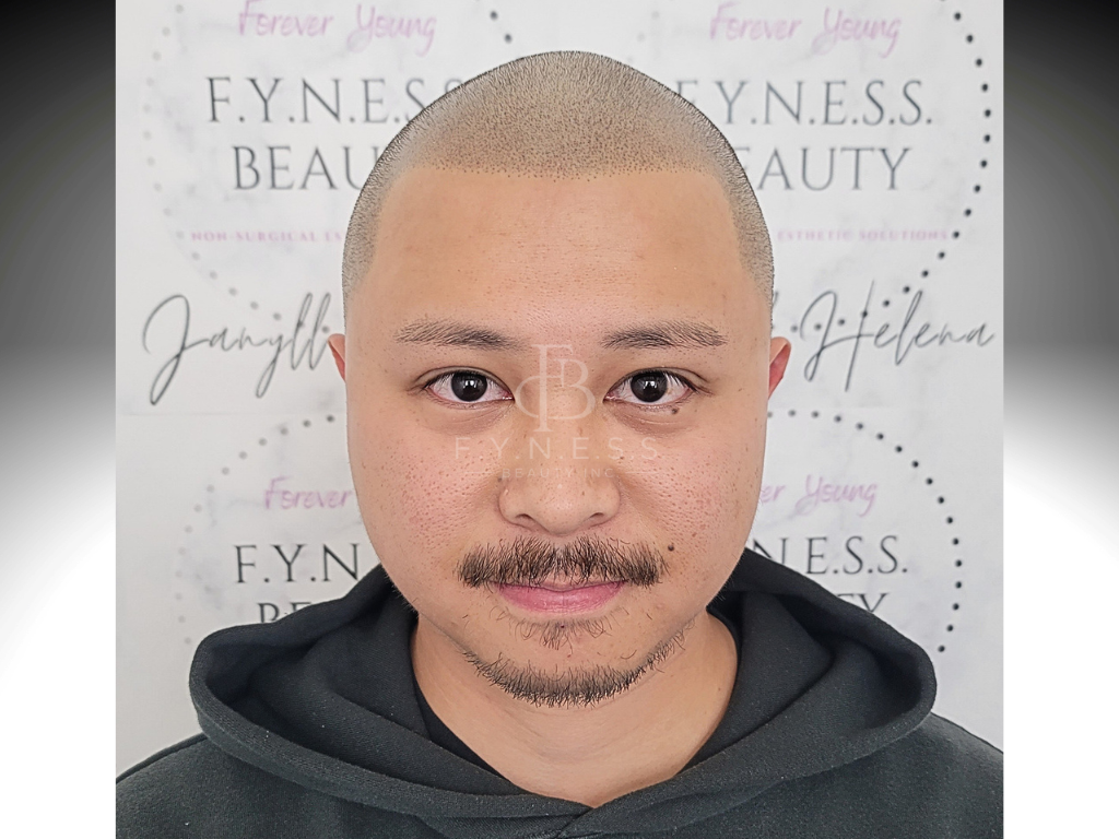 After hairline restoration scalp micropigmentation result — Edison NJ