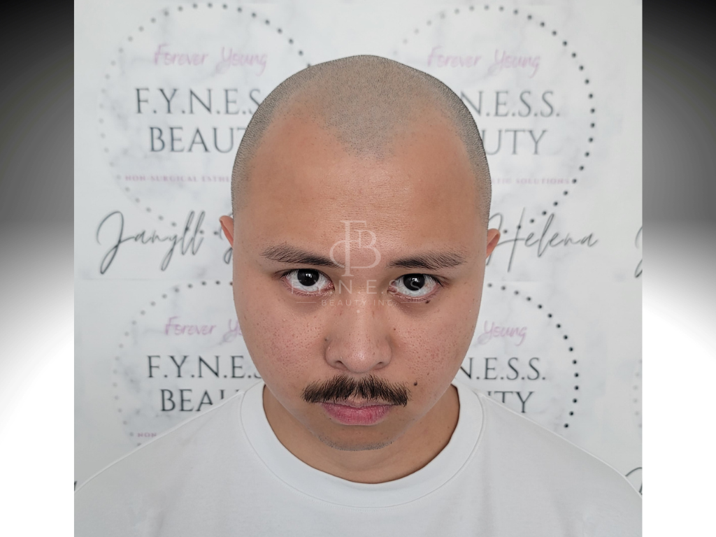 Before hairline restoration scalp micropigmentation — Edison NJ