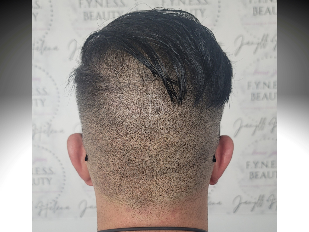 After hair transplant scar camouflage scalp micropigmentation — Central NJ