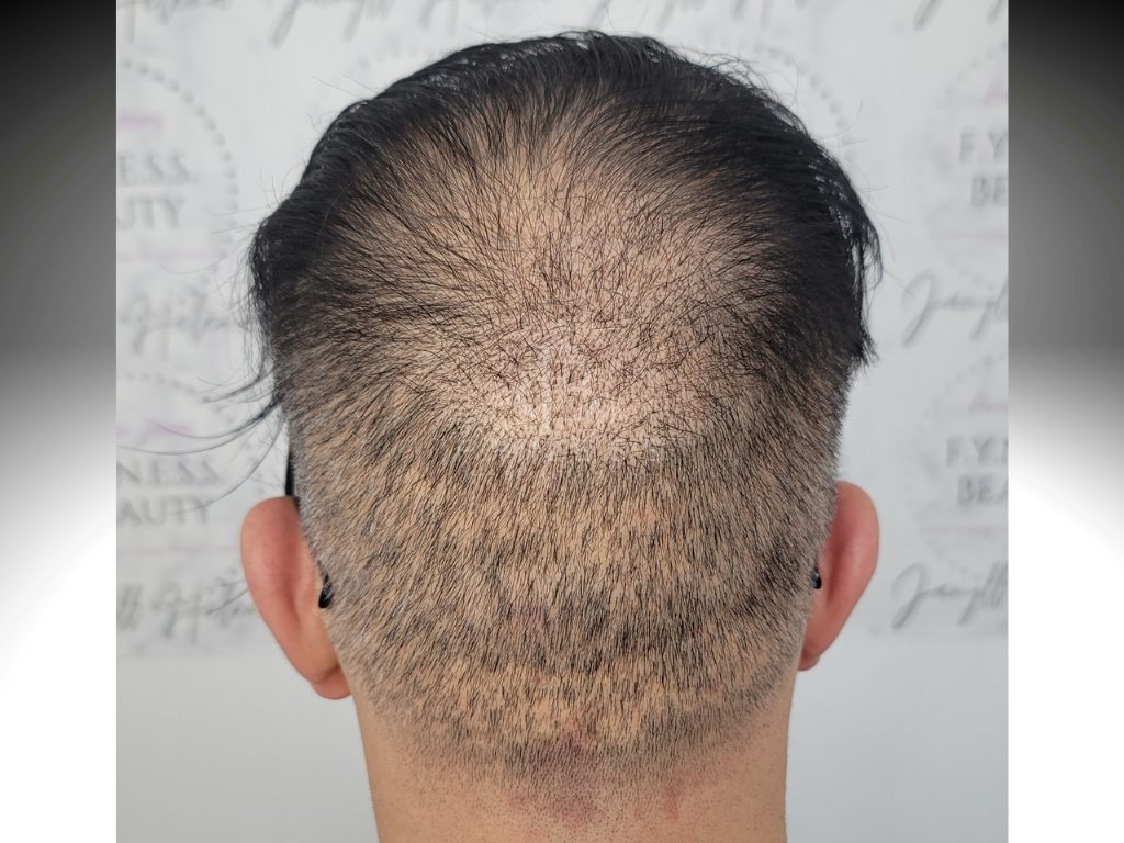 Before hair transplant scar camouflage SMP — Central NJ